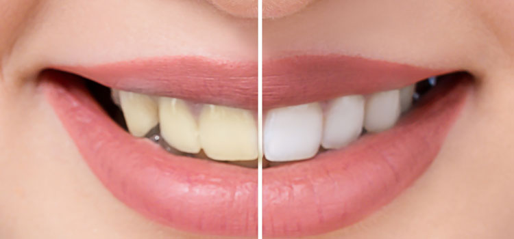 Cara Memutihkan Gigi Dengan Baik1
