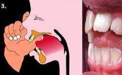 Kebiasaan Buruk Membahayakan Gigi Yang Mudah Dicegah1