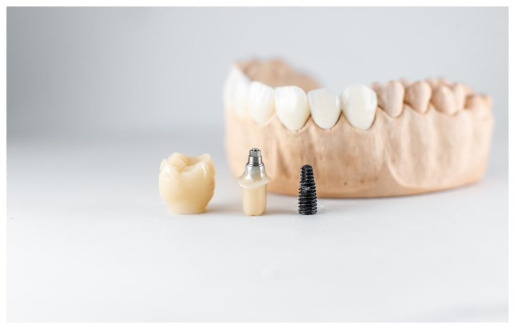 Implan Gigi Solusi Modern untuk Kehilangan Gigi