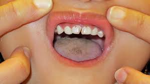 Pentingnya Pencegahan Karies pada Gigi Anak-anak