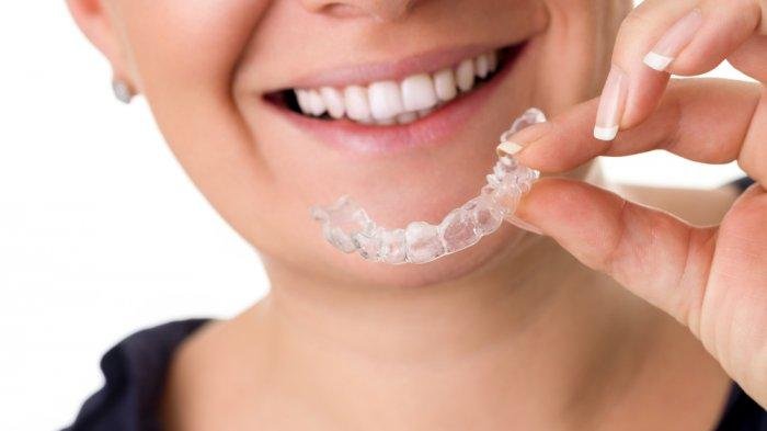 Tren dalam Dunia Ortodonti Invisalign dan Alternatifnya